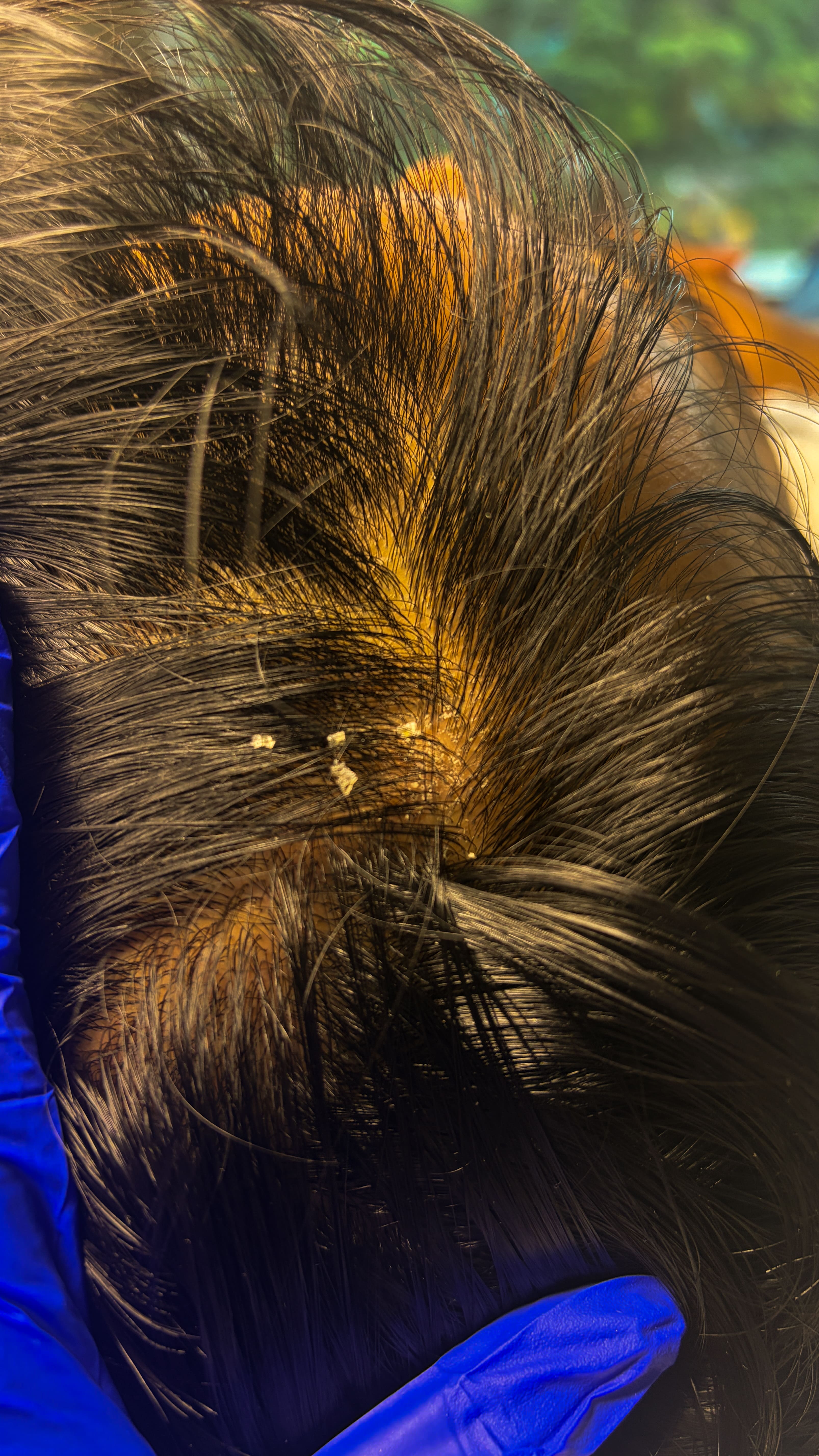 PRP Hair Therapy - Hair Regrowth & Density Before Result - Auraa Aesthetic Clinic Ravet Pune